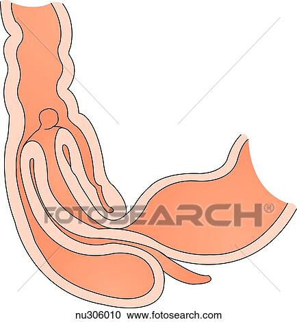 The distal ileal segment of bowel has invaginated into the cecum. A polyp serves as lead point. View Large Illustration Clipart - The distal ileal segment of bowel has invaginated into the cecum. A polyp serves as lead point.. Fotosearch
