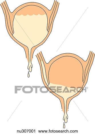 Clip Art - (Top) Normal bladder and voiding pattern. (Bottom) Bladder refluxing into ureters with voiding.. Fotosearch