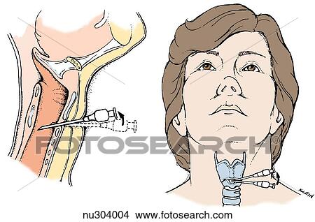 Stock Illustration - Two views of a cricothyroid membrane puncture. Left: sagittal view of neck region with needle inserted just above upper part of cricoid cartilage. Right: anterior view of head, with needle inserted below thyroid cartilage.. Fotosearch