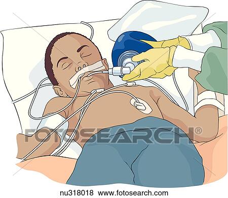 Young child wearing monitoring equipment and nasal tubes whose breathing is being facillitated by Ambu bag. View Large Illustration Stock Illustration - Young child wearing monitoring equipment and nasal tubes whose breathing is being facillitated by Ambu bag.. Fotosearch