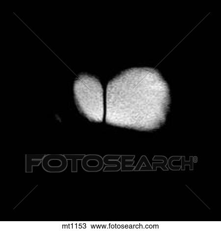 Abdomen - Coronal View Large Illustration Drawing - Abdomen - Coronal. Fotosearch