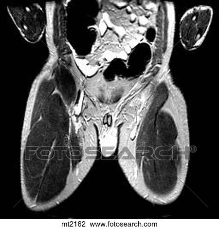 Drawing - Abdomen - Coronal. Fotosearch