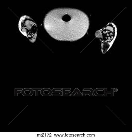 Drawing - Abdomen - Coronal. Fotosearch
