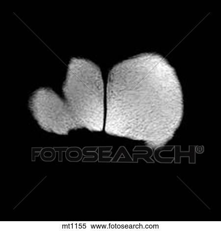 Abdomen - Coronal View Large Illustration Stock Illustration - Abdomen - Coronal. Fotosearch
