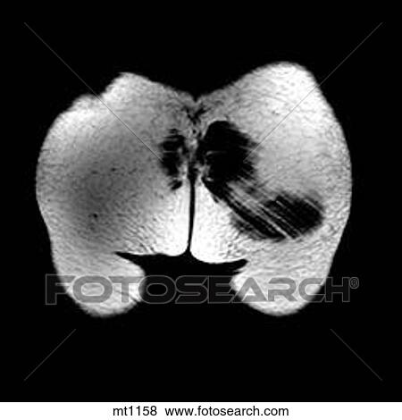Abdomen - Coronal View Large Illustration Stock Illustration - Abdomen - Coronal. Fotosearch