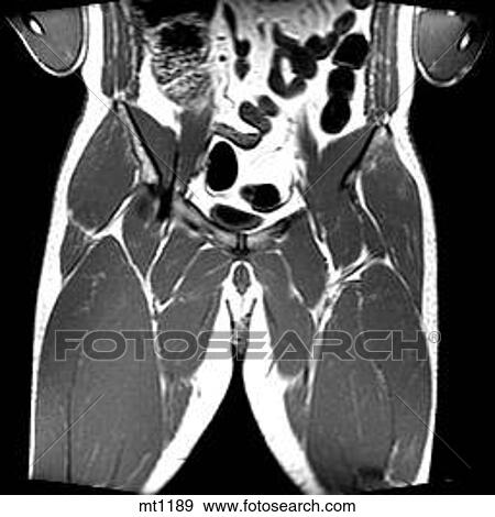 Stock Illustration - Abdomen - Coronal. Fotosearch