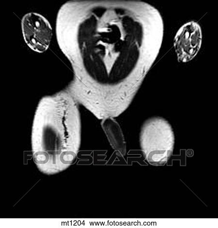 Abdomen - Coronal View Large Illustration Stock Illustration - Abdomen - Coronal. Fotosearch
