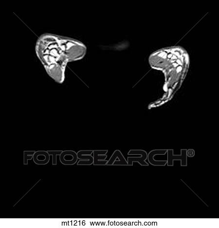 Stock Illustration - Abdomen - Coronal. Fotosearch