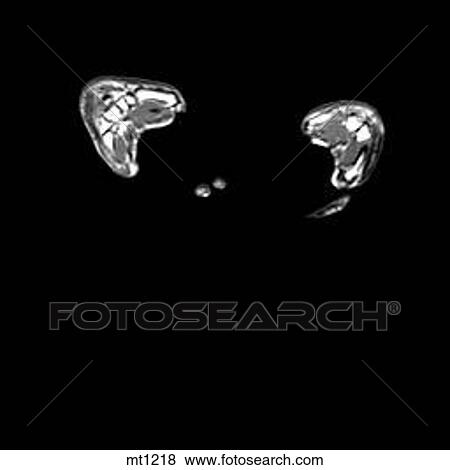 Abdomen - Coronal View Large Illustration Stock Illustration - Abdomen - Coronal. Fotosearch