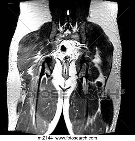 Abdomen - Coronal View Large Illustration Stock Illustration - Abdomen - Coronal. Fotosearch