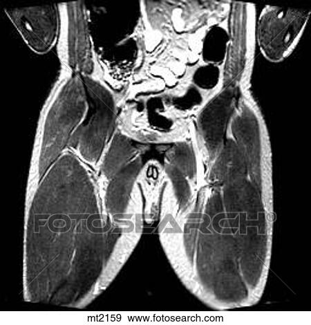 Stock Illustration - Abdomen - Coronal. Fotosearch