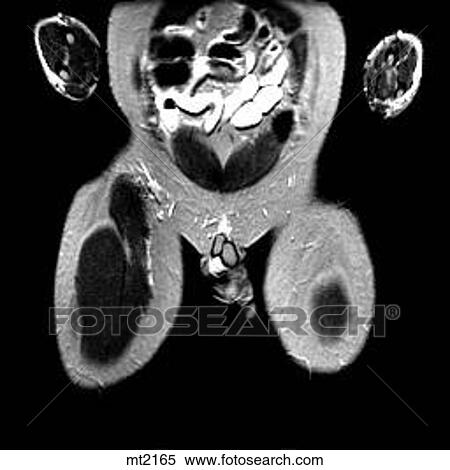 Abdomen - Coronal View Large Illustration Stock Illustration - Abdomen - Coronal. Fotosearch