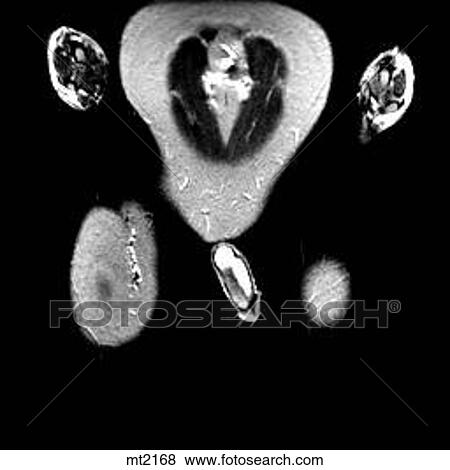 Abdomen - Coronal View Large Illustration Stock Illustration - Abdomen - Coronal. Fotosearch