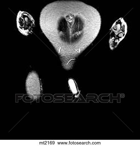 Abdomen - Coronal View Large Illustration Stock Illustration - Abdomen - Coronal. Fotosearch