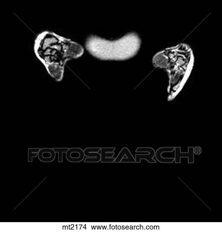 Abdomen - Coronal View Large Illustration Stock Illustration - Abdomen - Coronal. Fotosearch