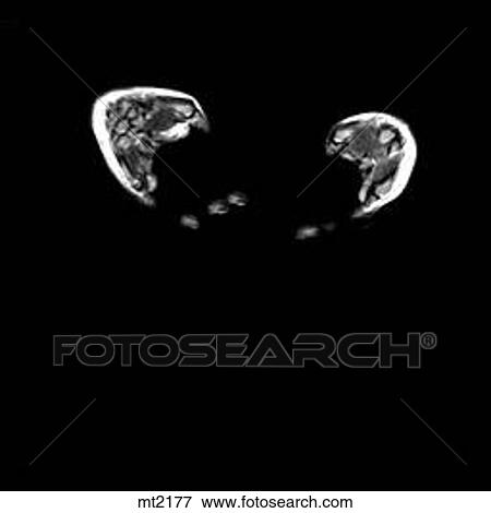 Abdomen - Coronal View Large Illustration Stock Illustration - Abdomen - Coronal. Fotosearch
