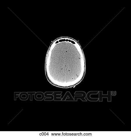 Stock Illustration - Head and Neck. Fotosearch