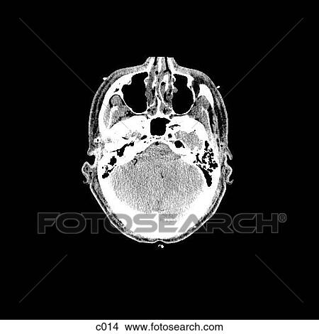 Stock Illustration - Head and Neck. Fotosearch