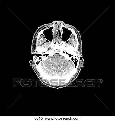 Stock Illustration - Head and Neck. Fotosearch