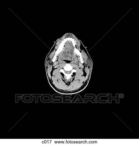 Stock Illustration - Head and Neck. Fotosearch