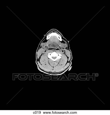 Stock Illustration - Head and Neck. Fotosearch