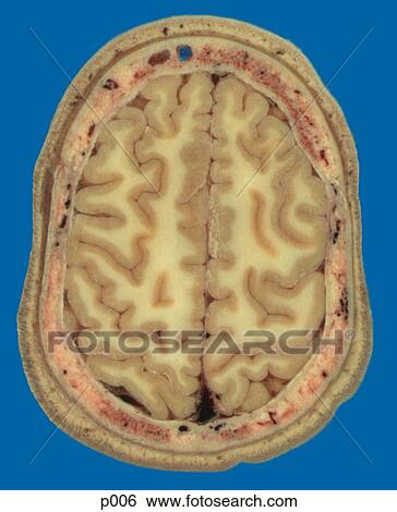Stock Illustration - Head and Neck. Fotosearch