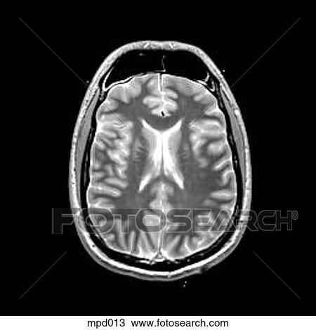 Head - Transverse View Large Illustration Drawing - Head - Transverse. Fotosearch