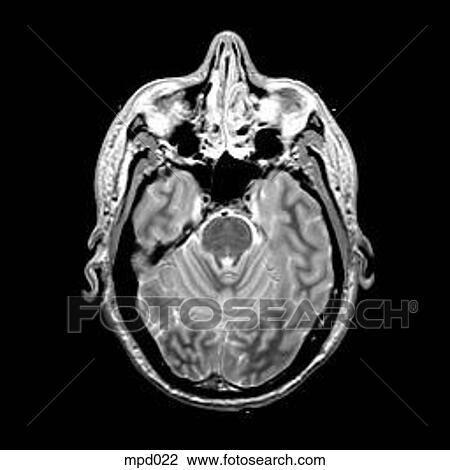 Head - Transverse View Large Illustration Drawing - Head - Transverse. Fotosearch