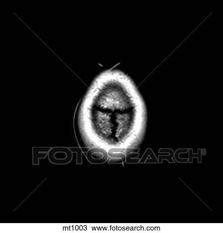 Head - Transverse View Large Illustration Drawing - Head - Transverse. Fotosearch