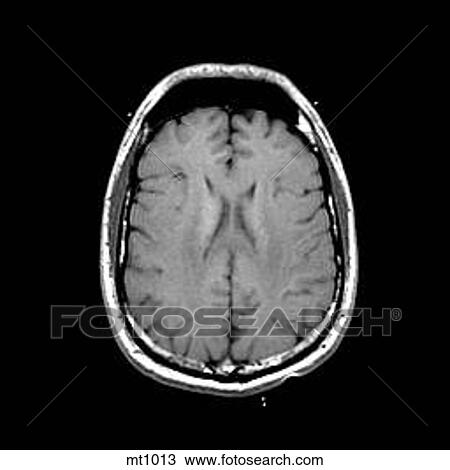 Head - Transverse View Large Illustration Drawing - Head - Transverse. Fotosearch