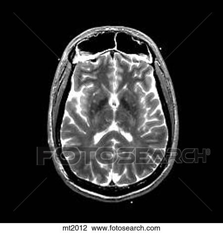 Head - Transverse View Large Illustration Drawing - Head - Transverse. Fotosearch