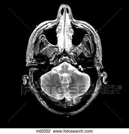 Head - Transverse View Large Illustration Drawing - Head - Transverse. Fotosearch