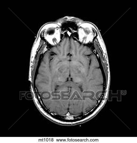 Head - Transverse View Large Illustration Stock Illustration - Head - Transverse. Fotosearch