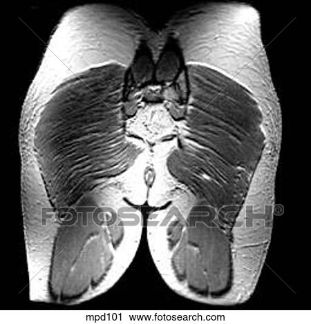 Hips/Legs - Coronal View Large Illustration Clip Art - Hips/Legs - Coronal. Fotosearch