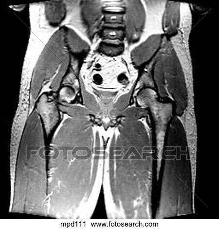 Hips/Legs - Coronal View Large Illustration Clip Art - Hips/Legs - Coronal. Fotosearch