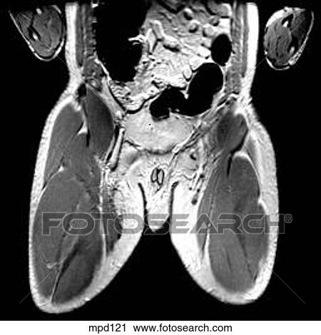 Hips/Legs - Coronal View Large Illustration Clip Art - Hips/Legs - Coronal. Fotosearch