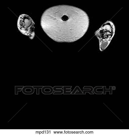 Hips/Legs - Coronal View Large Illustration Clip Art - Hips/Legs - Coronal. Fotosearch
