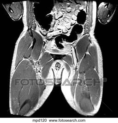 Hips/Legs - Coronal View Large Illustration Clipart - Hips/Legs - Coronal. Fotosearch