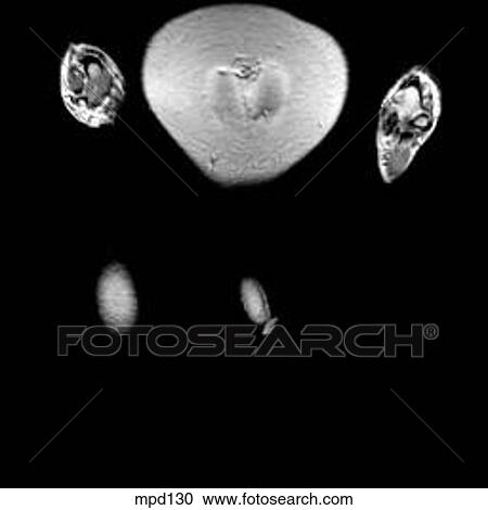 Hips/Legs - Coronal View Large Illustration Clipart - Hips/Legs - Coronal. Fotosearch