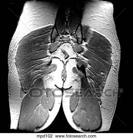 Hips/Legs - Coronal View Large Illustration Drawing - Hips/Legs - Coronal. Fotosearch
