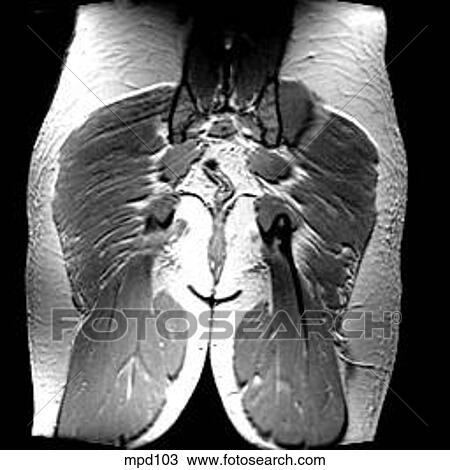 Drawing - Hips/Legs - Coronal. Fotosearch