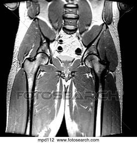 Hips/Legs - Coronal View Large Illustration Drawing - Hips/Legs - Coronal. Fotosearch