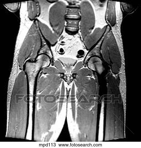 Hips/Legs - Coronal View Large Illustration Drawing - Hips/Legs - Coronal. Fotosearch