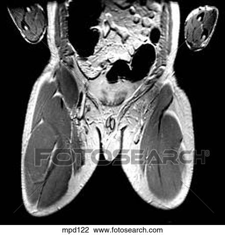 Hips/Legs - Coronal View Large Illustration Drawing - Hips/Legs - Coronal. Fotosearch