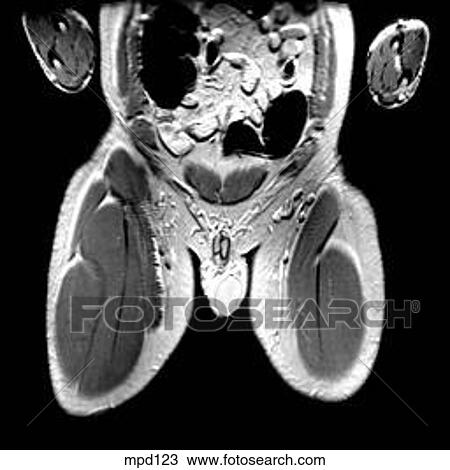 Hips/Legs - Coronal View Large Illustration Drawing - Hips/Legs - Coronal. Fotosearch