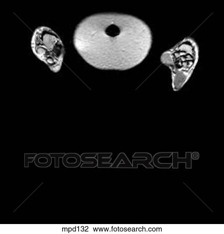 Drawing - Hips/Legs - Coronal. Fotosearch