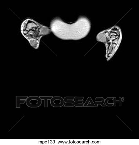 Hips/Legs - Coronal View Large Illustration Drawing - Hips/Legs - Coronal. Fotosearch