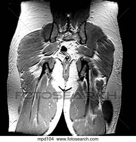 Hips/Legs - Coronal View Large Illustration Stock Illustration - Hips/Legs - Coronal. Fotosearch