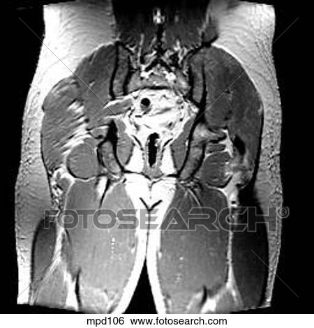 Hips/Legs - Coronal View Large Illustration Stock Illustration - Hips/Legs - Coronal. Fotosearch