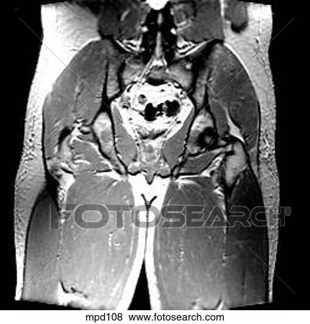 Hips/Legs - Coronal View Large Illustration Stock Illustration - Hips/Legs - Coronal. Fotosearch